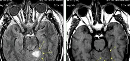 Akutni cerebrovaskularni infarkt Liječenje moždanog udara
