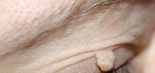 Riješite se papiloma na licu brzo i bez bolova Uzroci i liječenje papiloma na licu