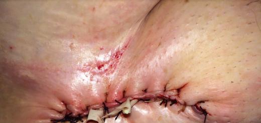Лечение на мацерация на кожата на краката Мацерация върху кожата при условия